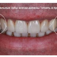 Разрушение жевательных зубов: основные причины и способы предотвращения